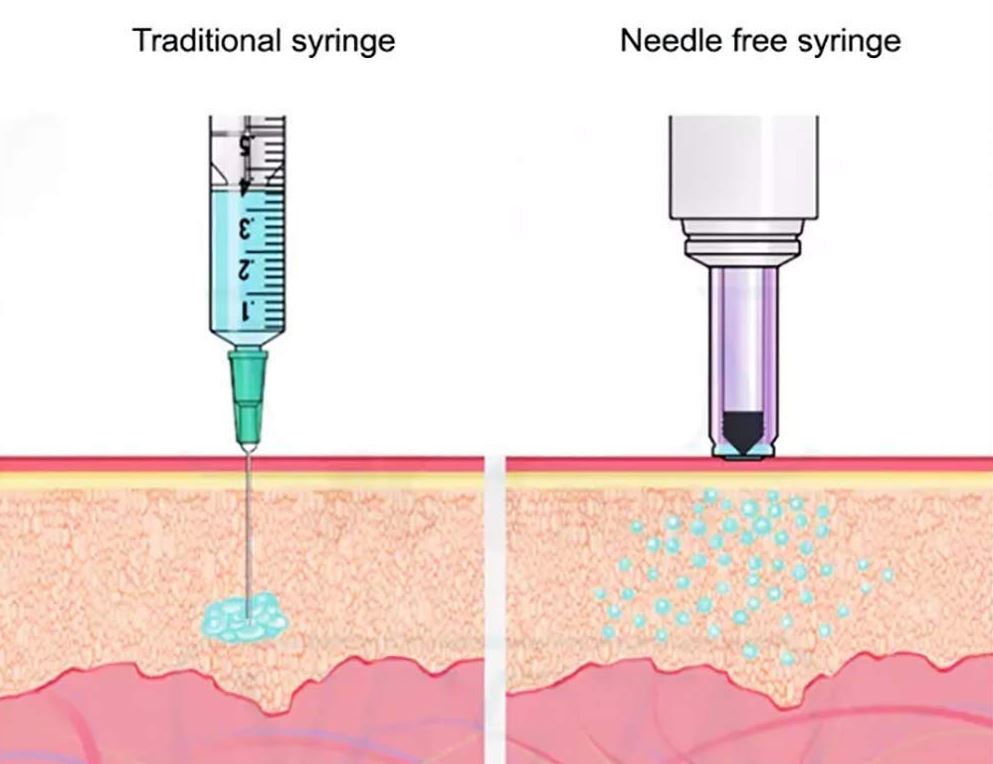 Needle vs Hyaluron Pen