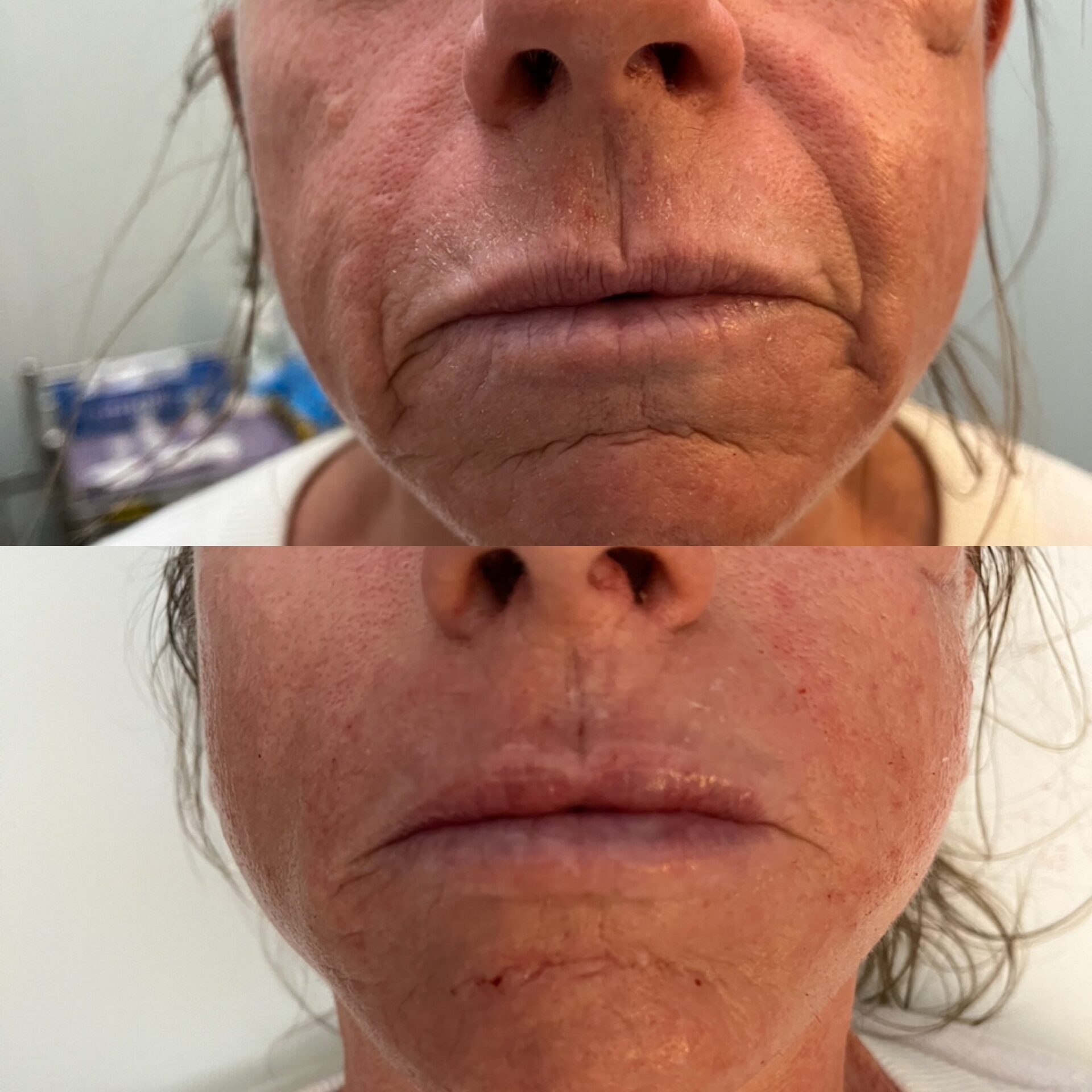 Faux Tox Nasolabial Folds and Marionette Lines