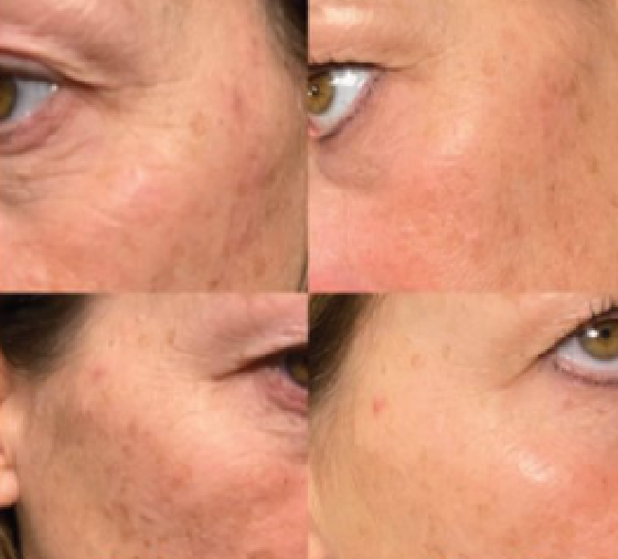 Facial Hyperpigmentation